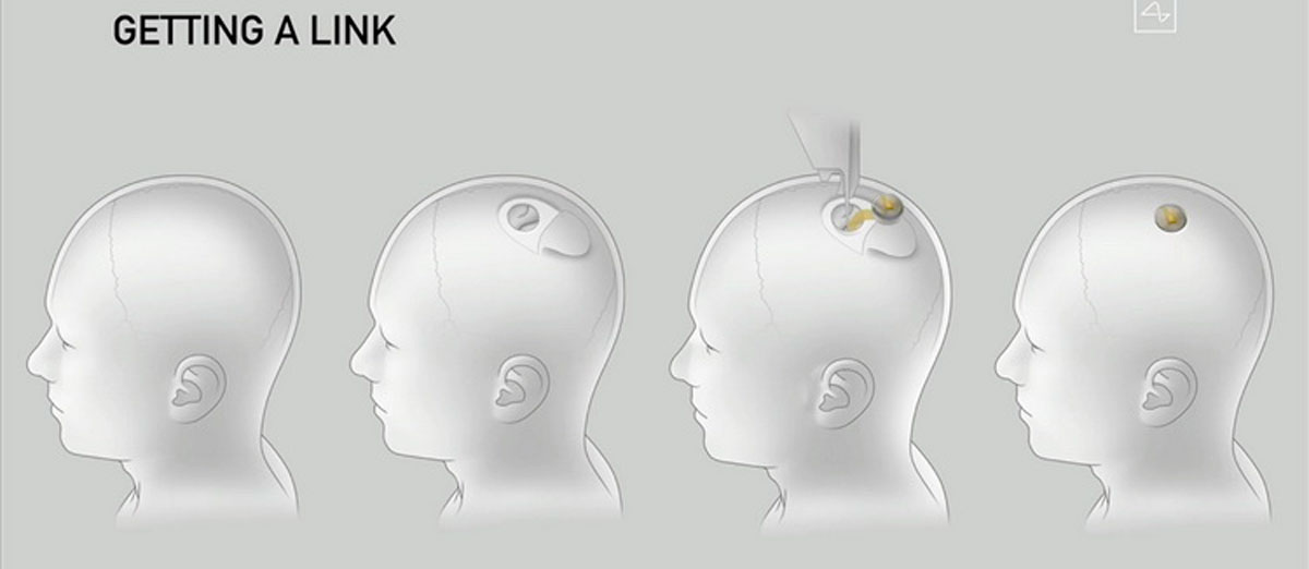 Resultados de la presentación del proyecto Neuralink - lo que dijo Elon Musk